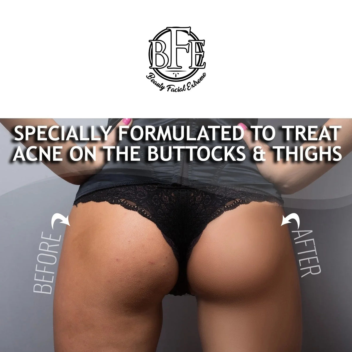 6.9 OZ. Prevents Future Breakouts. Anti-Acne Buttocks & Thigh Treatment- Clears Away Acne, Pimples, and Ingrown Hairs for the Buttocks and Thigh Area