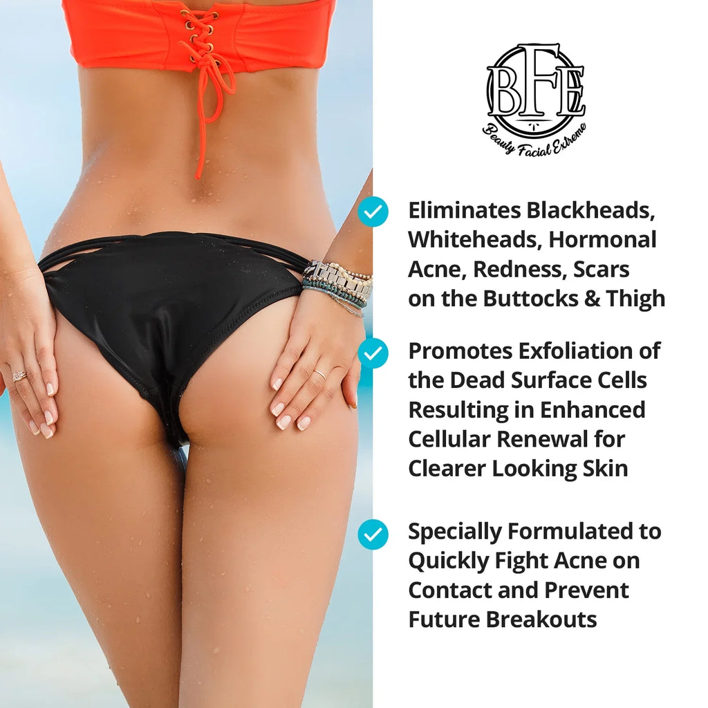 6.9 OZ. Prevents Future Breakouts. Anti-Acne Buttocks & Thigh Treatment- Clears Away Acne, Pimples, and Ingrown Hairs for the Buttocks and Thigh Area